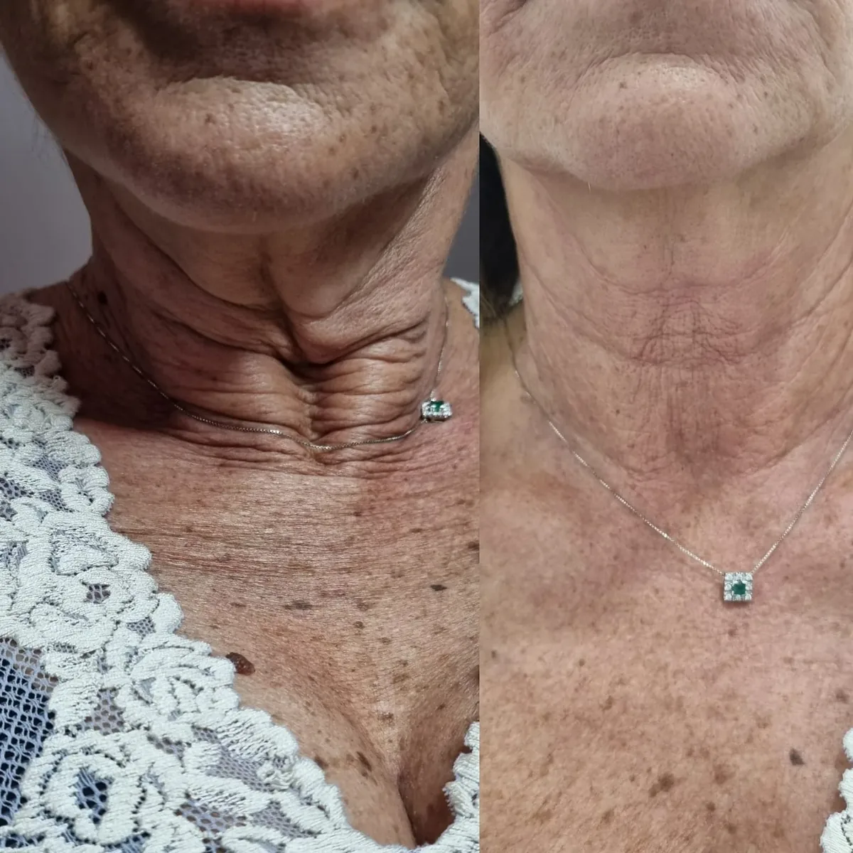 Collo e décolleté prima e dopo il trattamento