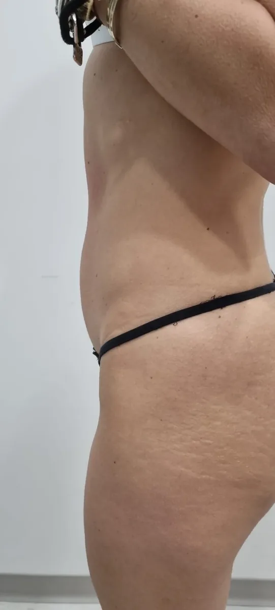 Addome prima del percorso di rimodellamento
