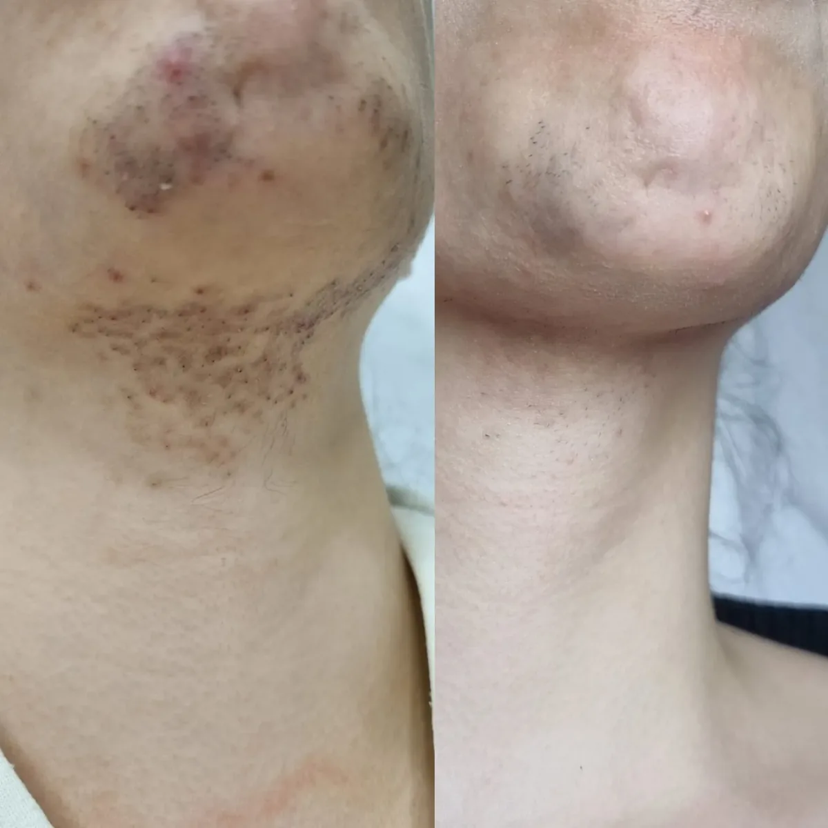 Mento e collo prima e dopo l'epilazione laser