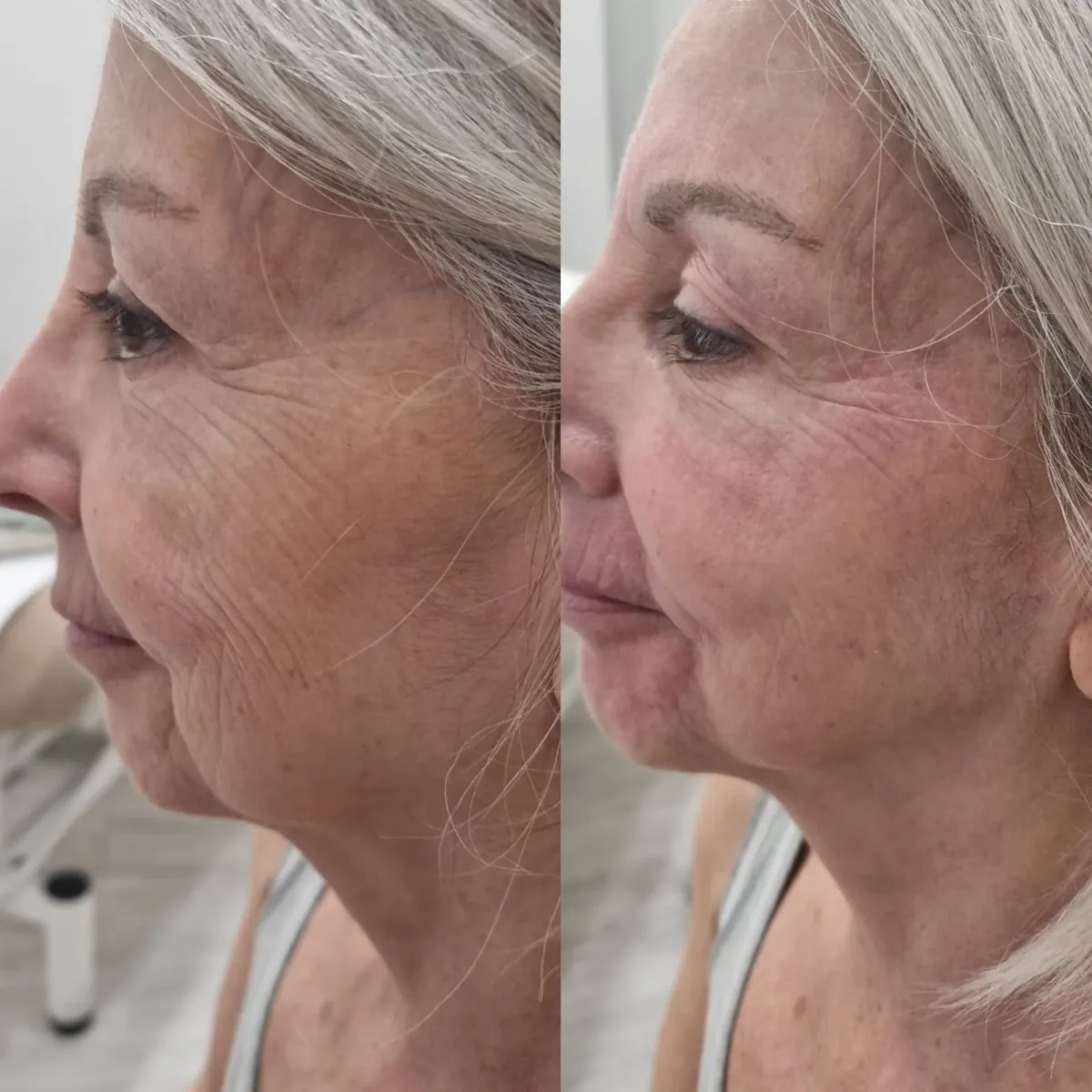 Viso prima e dopo un percorso di estetica avanzata