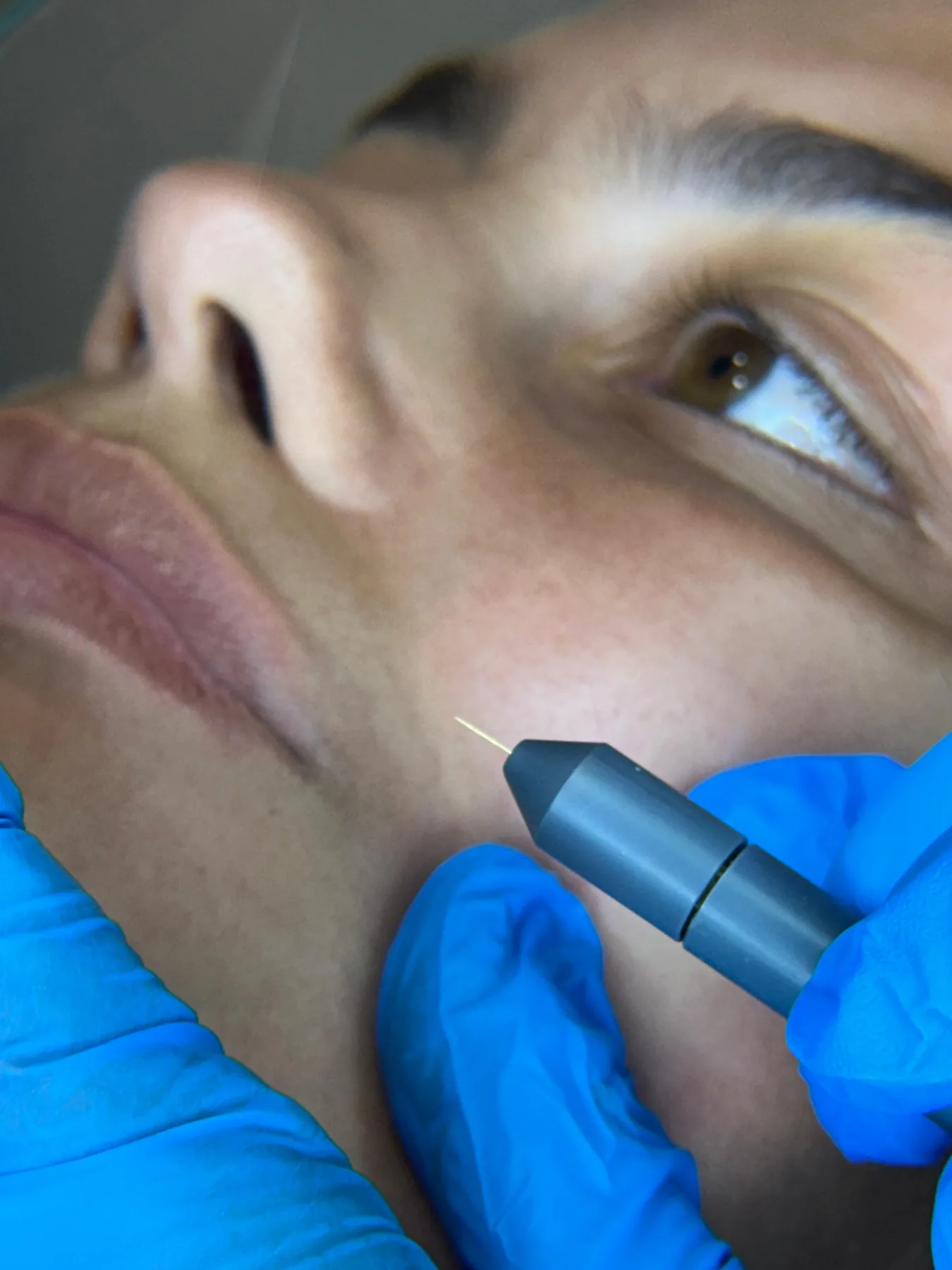Elettrodepilazione del viso con la sonda nel follicolo