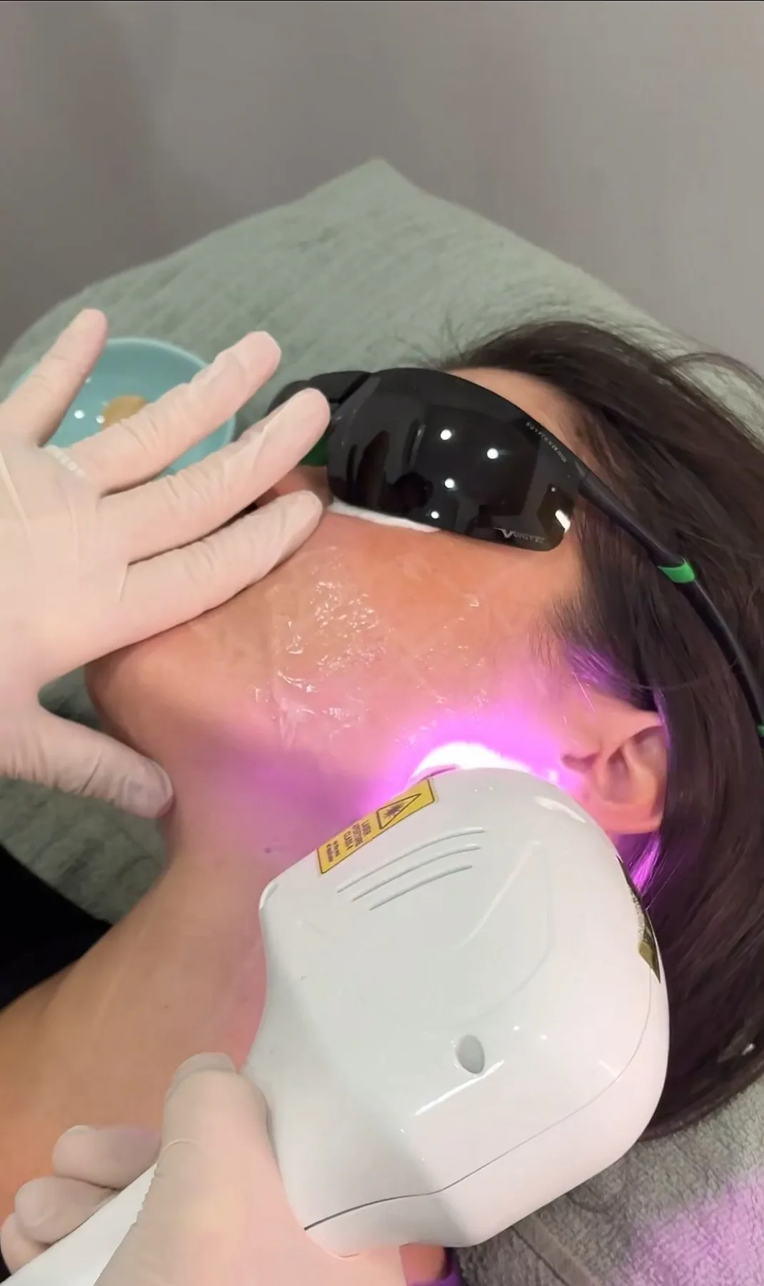 Il manipolo del laser durante una seduta di epilazione sul viso